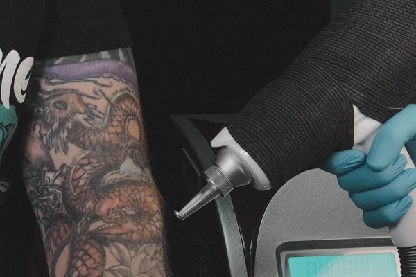 Laser tattoo removal in Katowice