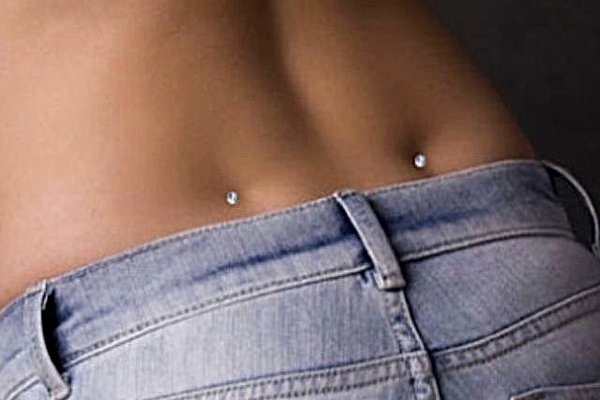 Dwa microdermale w dołkach lędźwiowych