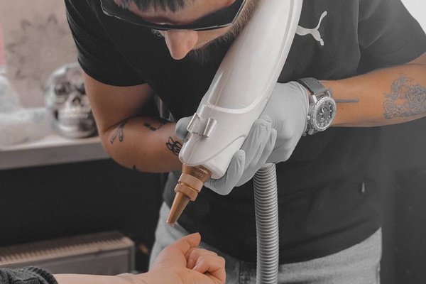 Laser tattoo removal in Kalish