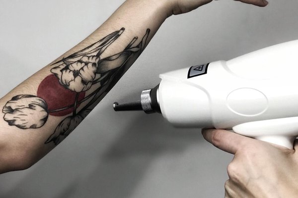 laser tattoo removal Bielsko-Biała