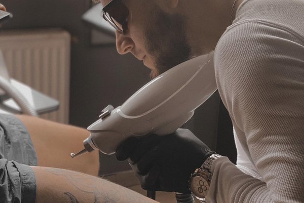 Tattoo Removal in Gliwice
