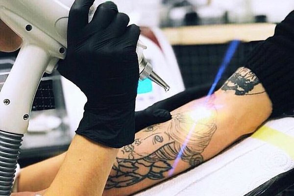 Usuwanie laserowe tatuaży w Rzeszowie