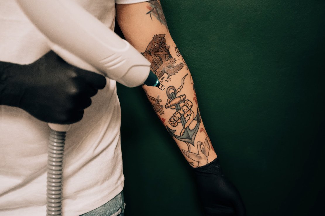 Tattoo Removal in Gdynia