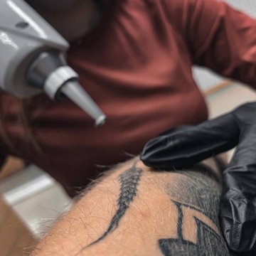 Tattoo Removal in Krakow