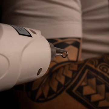 Laser Tattoo Removal in Lublin
