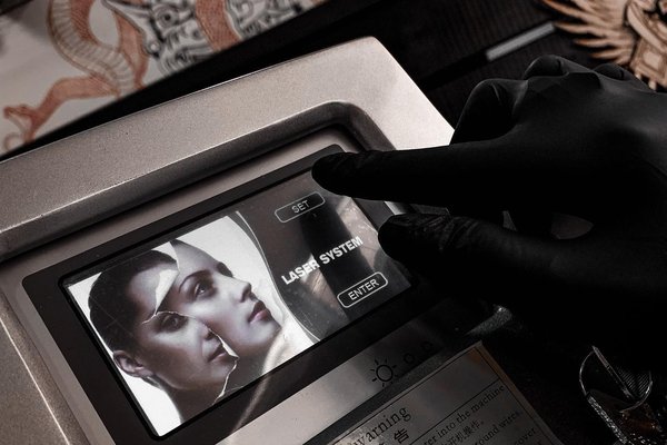 Laserowe usuwanie tatuażu w Gdańsku