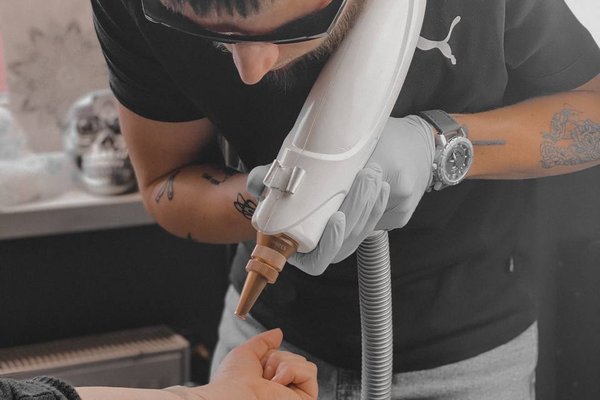 Laserowe usuwanie tatuażu w Zabrzu