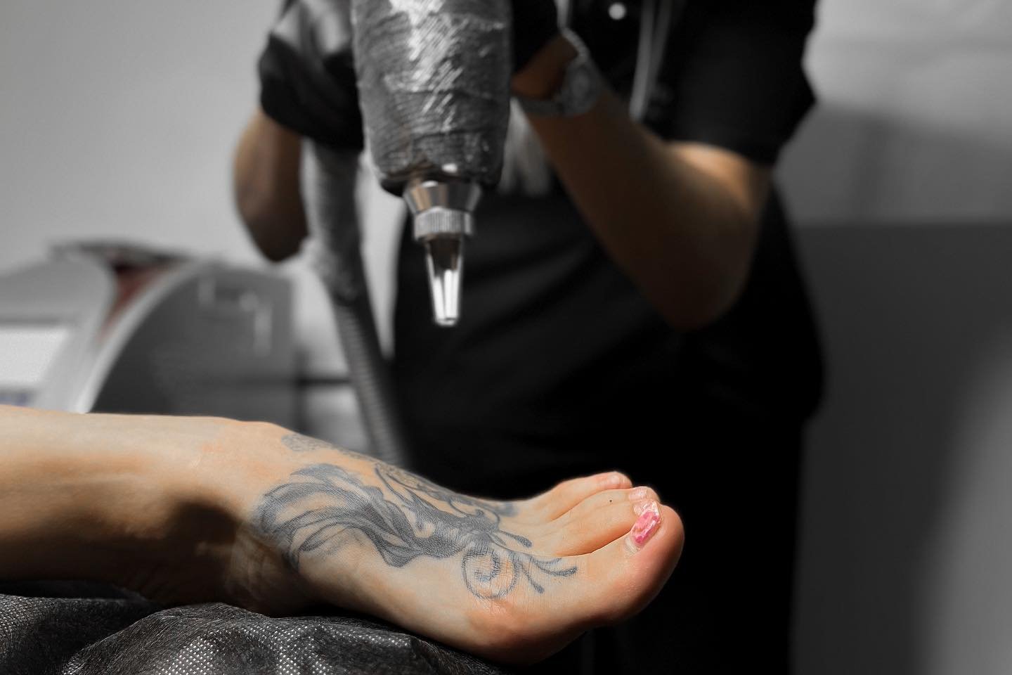 tattoo removal Szczecin