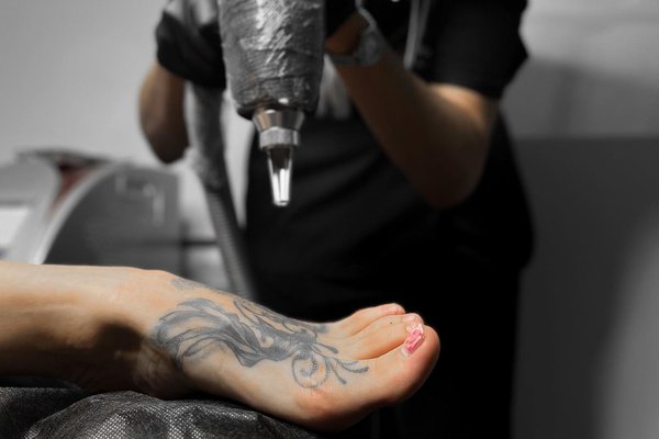 Laser Tattoo Removal in Poznan