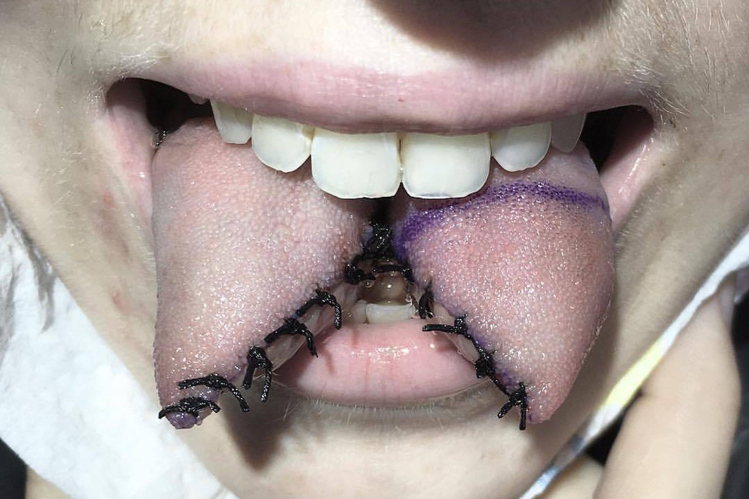 Tongue splitting
