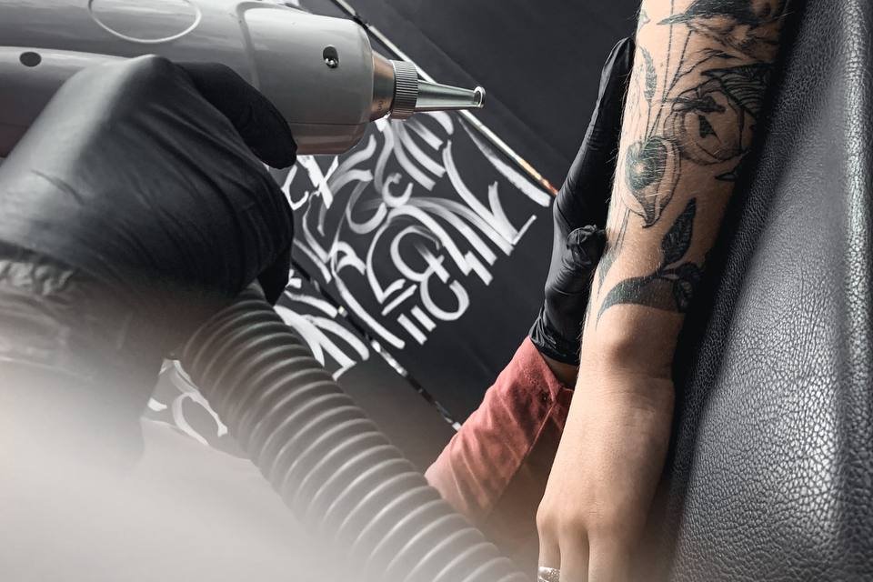 Tattoo removal Warsaw