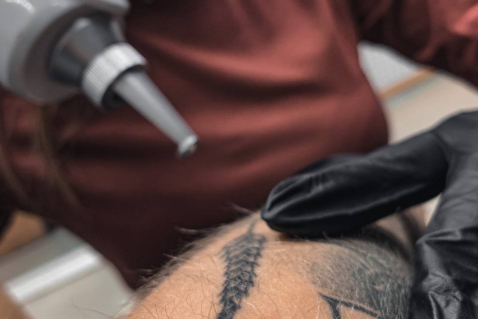 tattoo removal Gdansk